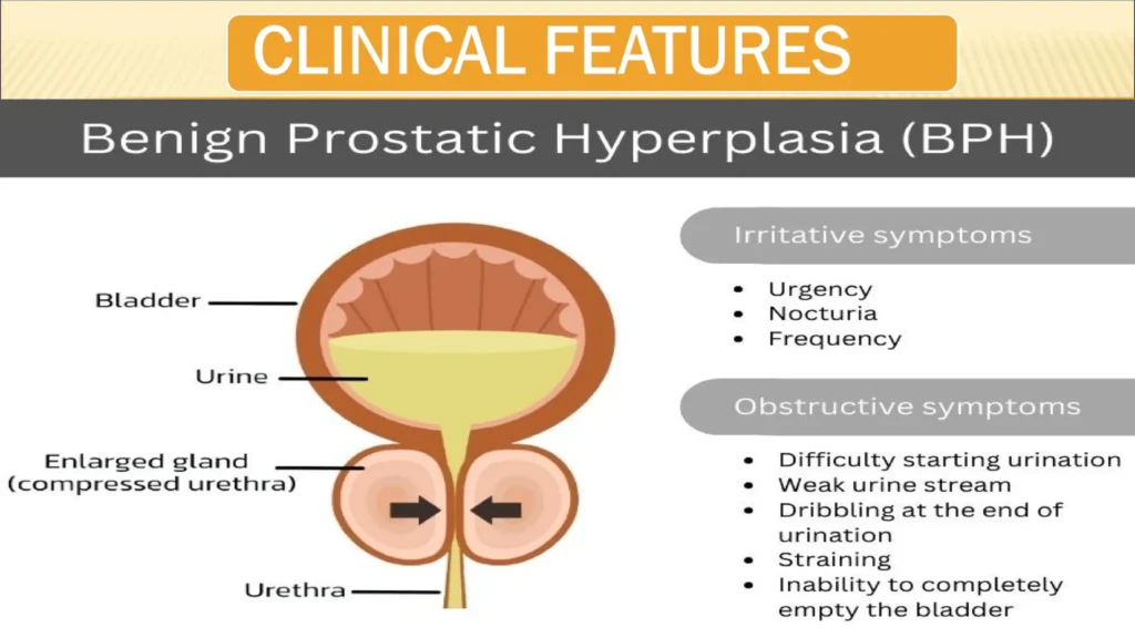 BPH Treatment in Delhi and bahadurgarh benign prostate hyperplasia power point presentation 9 2048 (1)