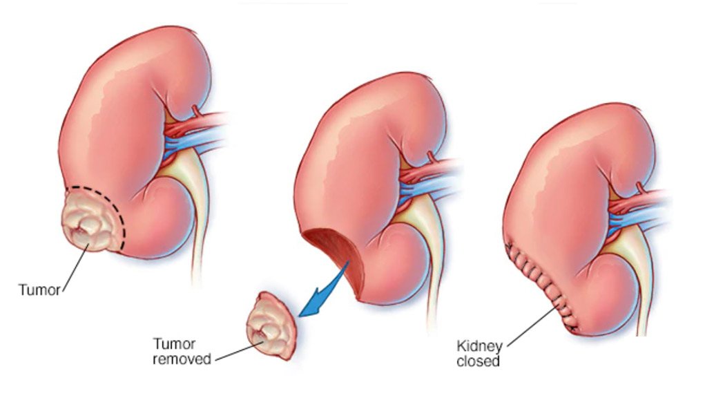 Nephrectomy In Delhi and Bahadurgarh laparoscopic partial nephrectomy bhopal