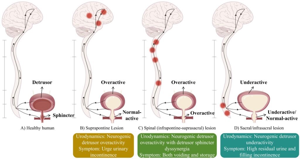 Neurogenic Bladder Treatment in Delhi & Bahadurgarh fcimb 15 1512891 g001