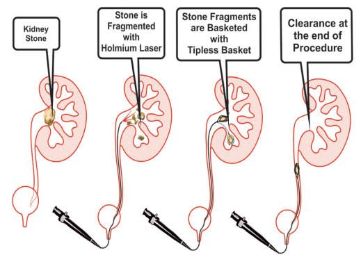 Laser Kidney Stone Surgery in Delhi and Bahadurgarh images