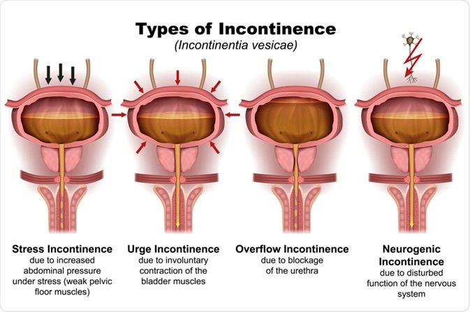 Incontinence Treatment in Delhi and Bahadurgarh shutterstock 1313939708