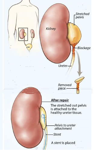 Pyeloplasty in Delhi and Bahadurgarh steps in pyeloplasty