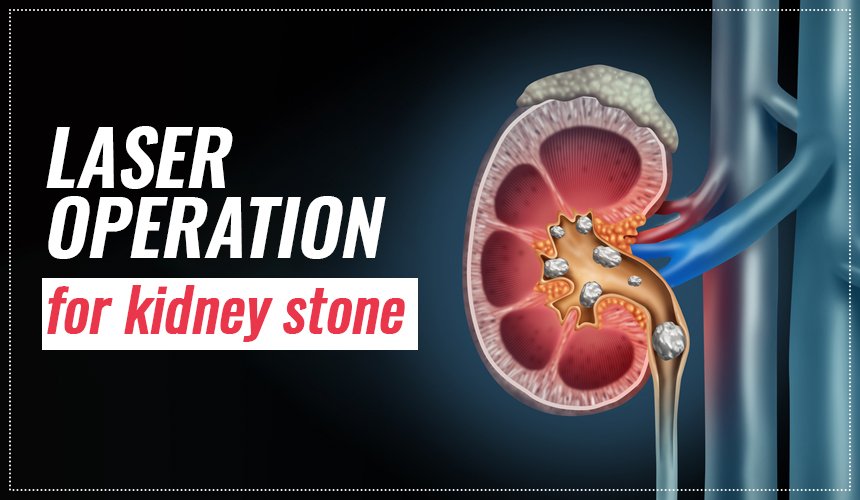 Laser Kidney Stone Surgery in Delhi and Bahadurgarh world of urology laser surgery 860